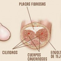 Cirugía de desviación de pene