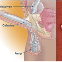 penis prostheses