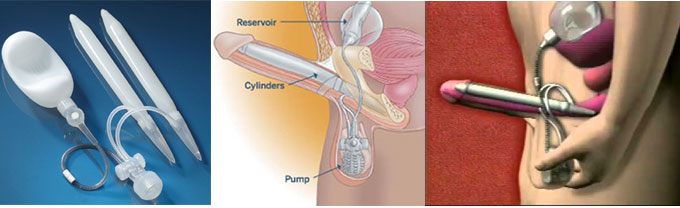 penis prostheses