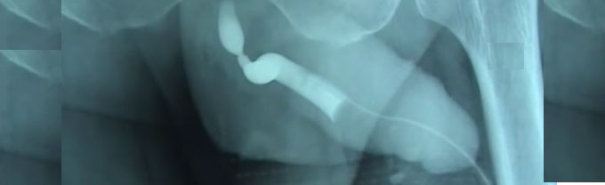 uretroplastia