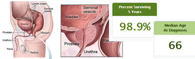 Datos sobre cáncer próstata