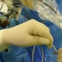 stent urológico temporal (iTIND)