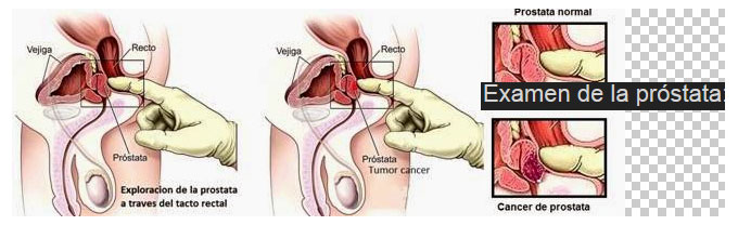 tacto rectal cáncer de próstata azitral pentru prostatită