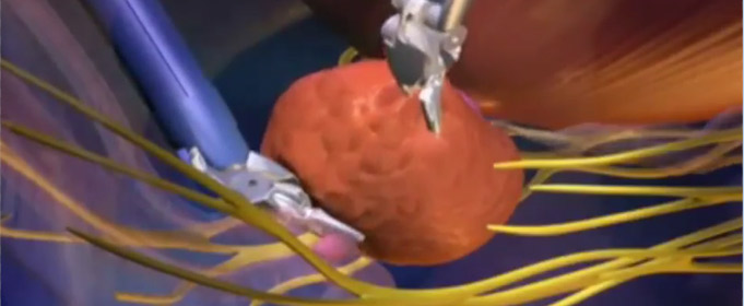 Datos cáncer próstata