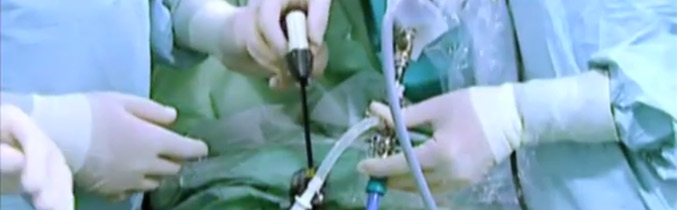 láser holmium, verde, tulio