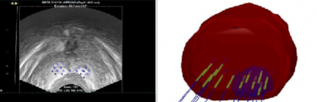 Terapia Focal , cancer prostata