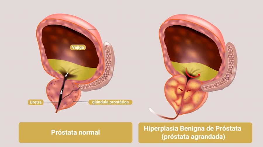 cirugia-Hiperplasia-benigna-de-prostata